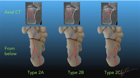 Sanders Classification Of Calcaneal Fractures Uw Emergency Radiology