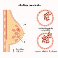 Was Brustkrebs ist wo er entsteht Symptome und Früherkennung