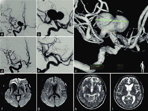 Case 1 Preoperative Digital Subtraction Angiography DSA Showing A