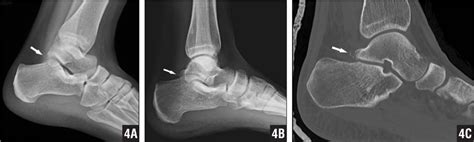 Posterior Ankle Impingement Bony — Rayner And Smale