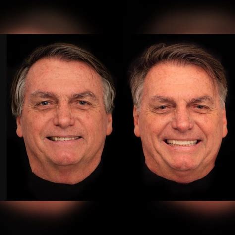 Bolsonaro Faz Harmoniza O Facial De R Mil Veja Antes E Depois