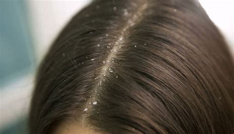 5 Major Causes Of Dandruff