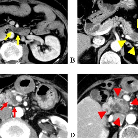 A Patient Was Diagnosed With Branch Duct Intraductal Papillary Mucinous