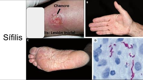 Sífilis Y Sus Síntomas cuáles Son Y Cómo Tratarla Salud Diez Images