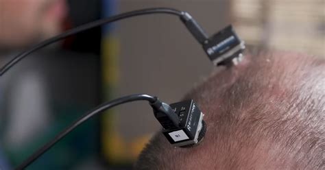 Groundbreaking Brain Chip Allows Man With Als To Speak Again