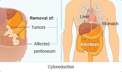 Cytoreductive Surgery with HIPEC | Treating Peritoneal Mesothelioma