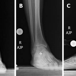 Comparison Of Pre And One Year Post Operative Standing X Rays