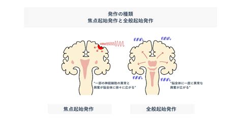 てんかんの診断と治療 九州大学病院福岡県てんかん支援病院