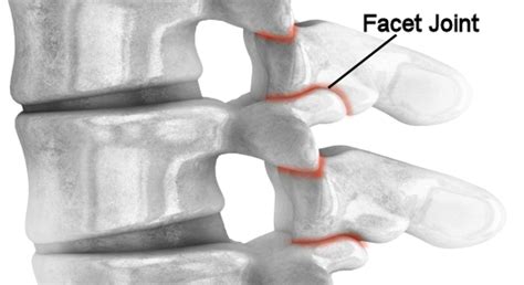 Medial Branch Blocks Renner Pain And Spine