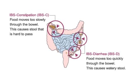 Irritable Bowel Syndrome (IBS) - Gastroenterologist