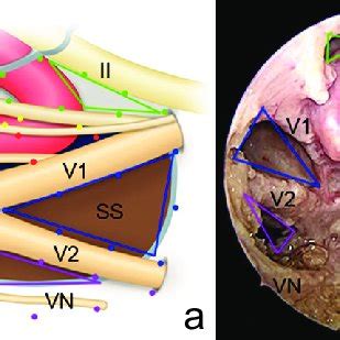 Endoscopic Anatomy Of Cavernous Sinus Triangles A The Dura Mater Over