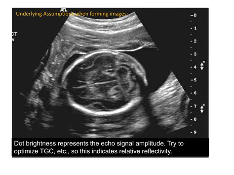 Reverberation Artifacts In Ultrasound Imaging Ppt