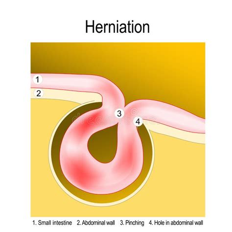 Strangulated Hernia Stock Illustrations 43 Strangulated Hernia Stock