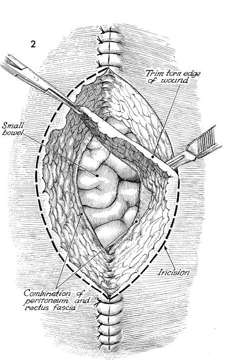 Abdominal Wound Dehiscence And Evisceration