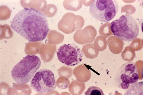 Chronic Myeloid Leukemia (CML) - Oncology - Medbullets Step 1