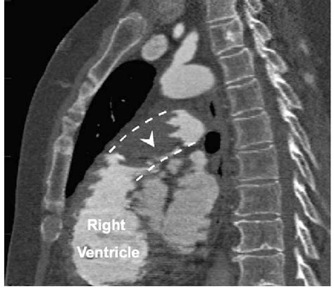 Computerized Tomography Scan Of The Chest Sagittal View Of The Download Scientific Diagram