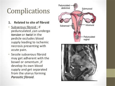 Fibroid Uterus By Dr Waseem Sajjad