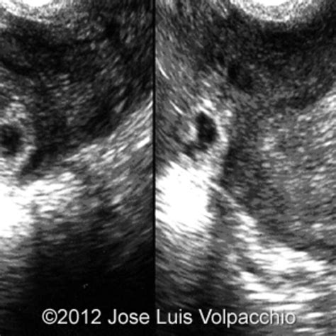 📃 Interstitial ectopic pregnancy