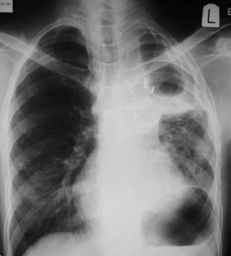 Chest Radiograph Postero Anterior View Showing Residual Pleural Space