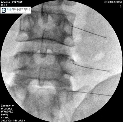 허리 신경차단술 치료 종류 수원 정형외과 통증의학과 Mbb Root Esi Ste Caudal Psoas Block