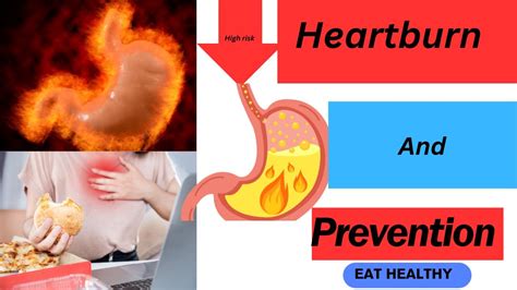 Heartburn 101 Understanding Heartburn Causes Prevention And Dietary