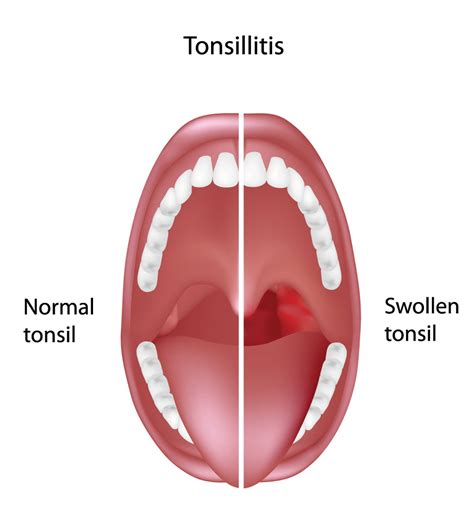 Tonsil Hypertrophy (Enlarged Tonsils) - Otolaryngology Specialists of ...