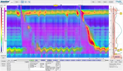 Synmed Medicinteknik Ab Embletta® Mrp Mpr Pg