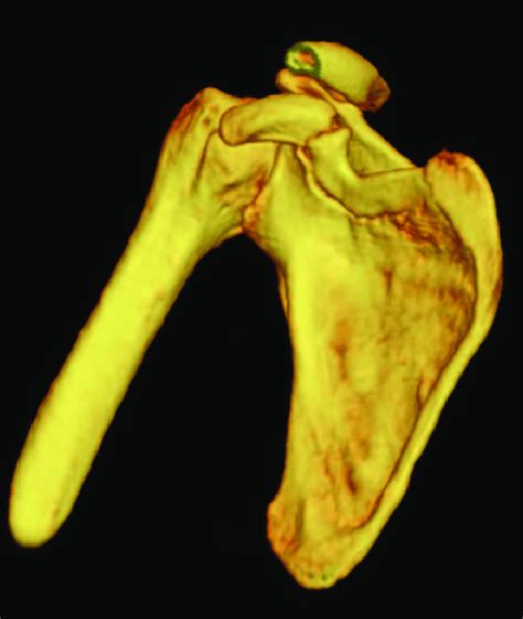 Preoperative 3d Ct Showed A Displaced Fracture Of The Coracoid Process Download Scientific