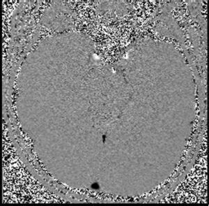 Phase contrast fow MRI | Phase contrast CSF and blood MRI physics and ...