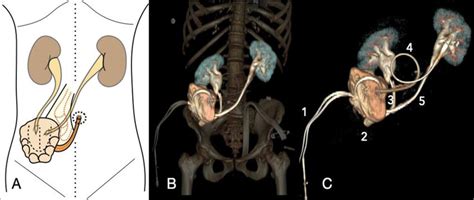 Continent Self Catheterizable Miami Pouch A Schematic Picture Of The