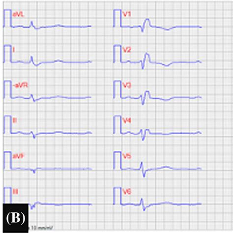 A Chest X Ray Showing Dextrocardia B Electrocardiogram Ecg With