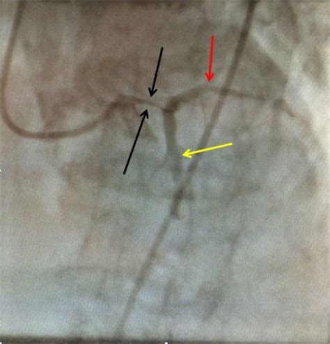 Dr Smiths Ecg Blog A Hybrid Of De Winters T Waves And Diffuse