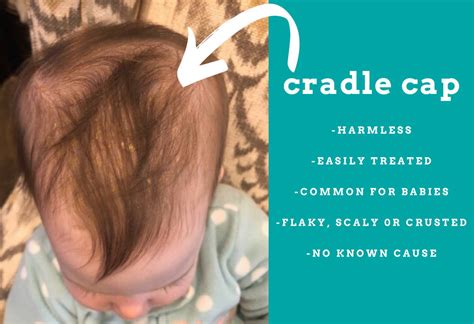 Cradle Cap What It Is Where Does It Occur How Do You Treat It T