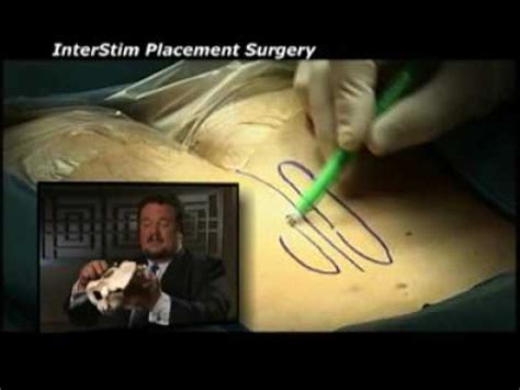 Interstim Placement Procedure - YouTube