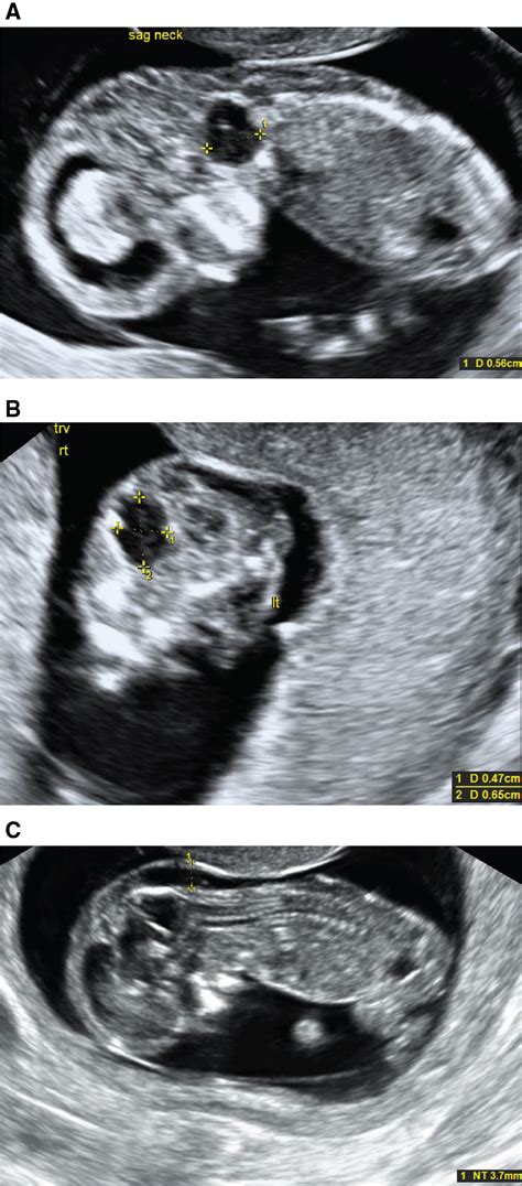 Trisomy Presenting In The First Trimester As A Fetal Lateral Neck