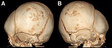 Three Dimensional Computed Tomographic Reconstruction At The Age Of 2 Download Scientific