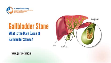 5 Main Cause Of Gallbladder Stones Dr Kapileshwer Vijay