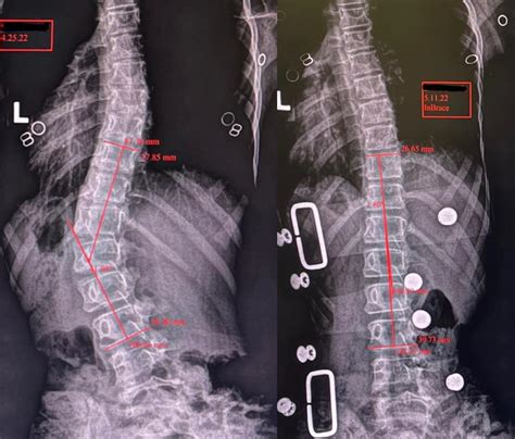 Strauss Scoliosis Correction Keeping Patients Ahead Of The Curve