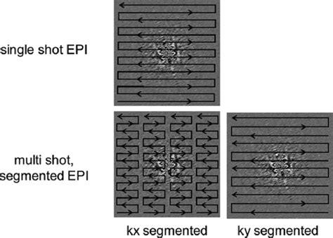 Segmented Echo Planar Imaging A Drawback To Single Shot Echo Planar Download Scientific