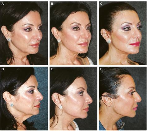 Many patients ask me how long a #deepplanefacelift lasts, and it is a ...