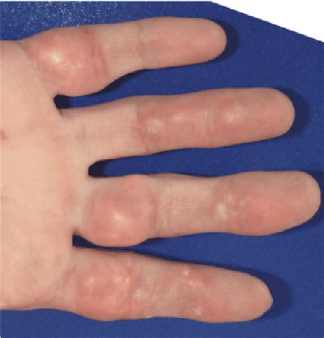 Figure From Calcinosis Cutis Of Juvenile Dermatomyositis Treated With