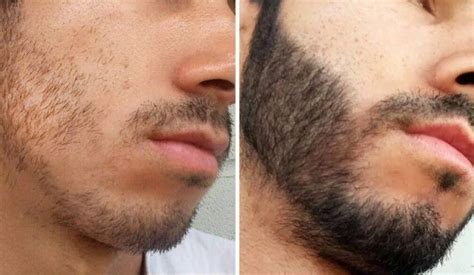 Cómo Hacer Crecer La Barba Naturalmente Maripo