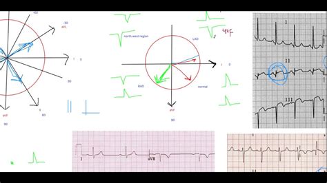 Ecg Basics Part 2 Electrical Axis Of Pqrst And St Youtube