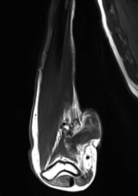 MRI, T1‐weighted image with contrast showing the patient's soft tissue ...