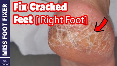 Fix Cracked Feet Cracked Heel Skin Removal Full Treatment By Miss