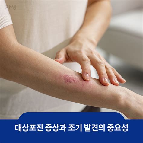 대상포진 초기증상과 치료방법 6가지 정보 사이트