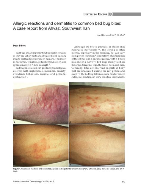 Bed Bug Bites Rash Images