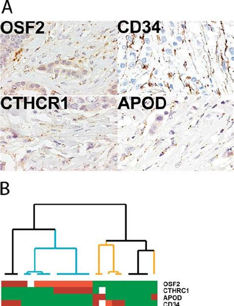 Fibroblast Markers In Breast Carcinoma A Examples Of Sft Apod Ish