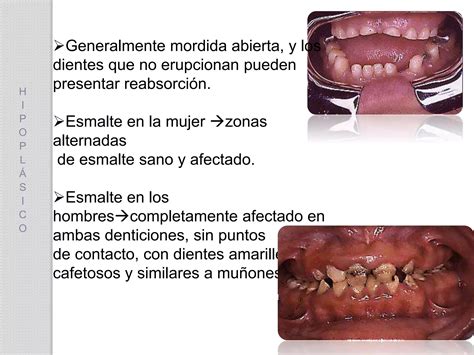 AMELOGÉNESIS IMPERFECTA PPT