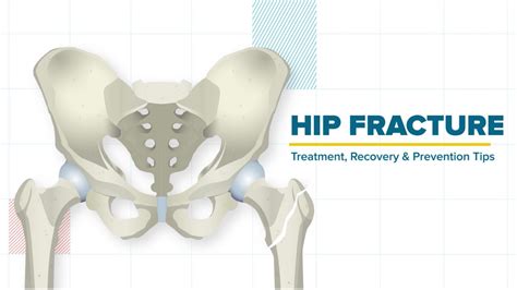 Hip Fracture Treatment Recovery Prevention Tips YouTube